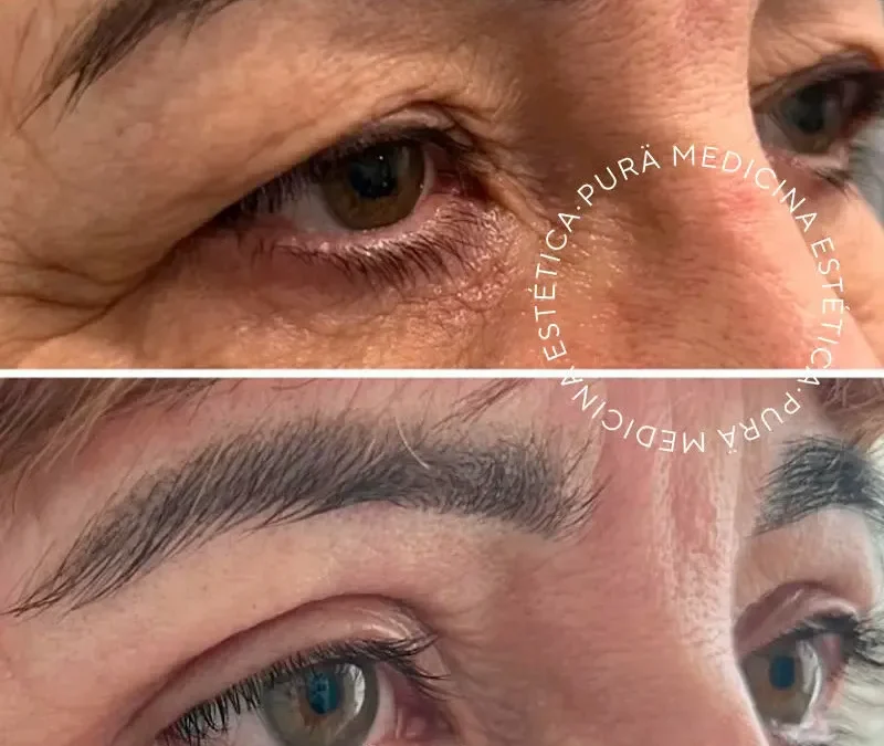 Revoluciona Tu Mirada: Carboxiterapia y Blefaroplastia CO2 para una Transformación Audaz